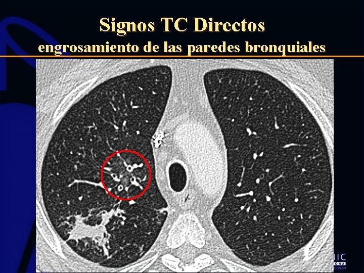 Signos TC Directos engrosamiento de las paredes bronquiales 