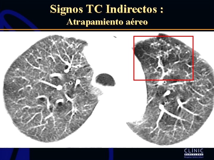 Signos TC Indirectos : Atrapamiento aéreo 