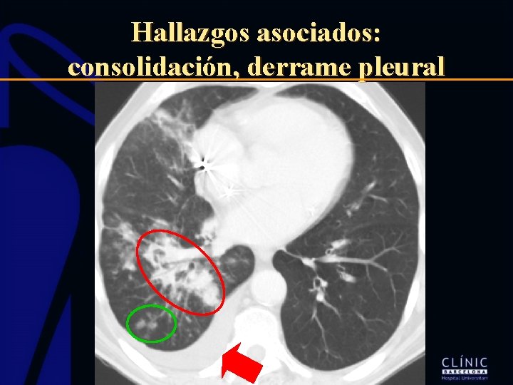 Hallazgos asociados: consolidación, derrame pleural 