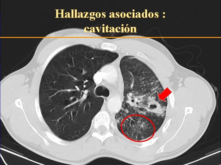 Hallazgos asociados : cavitación 