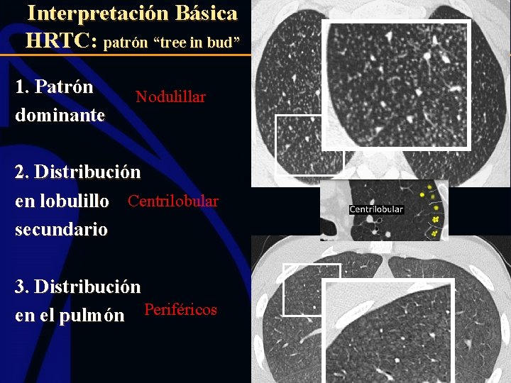 Interpretación Básica HRTC: patrón “tree in bud” 1. Patrón dominante Nodulillar 2. Distribución en