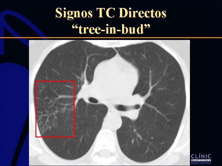 Signos TC Directos “tree-in-bud” 