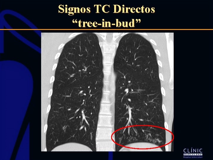 Signos TC Directos “tree-in-bud” 