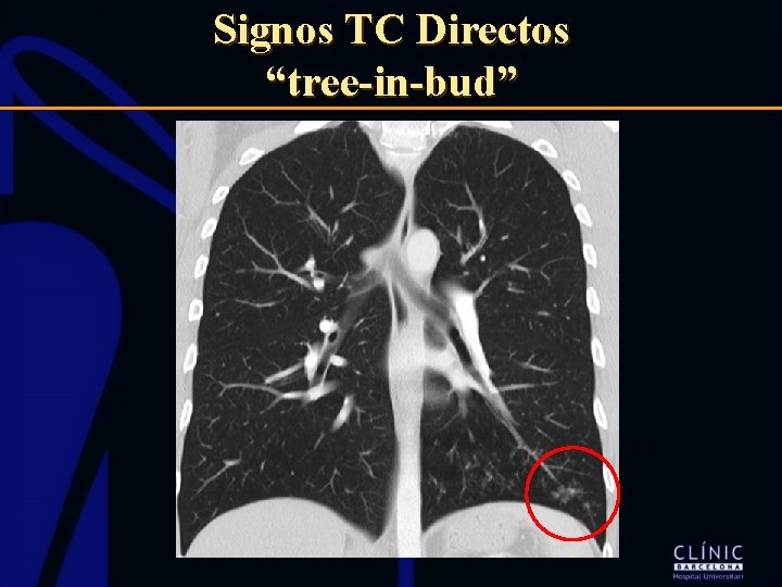 Signos TC Directos “tree-in-bud” 