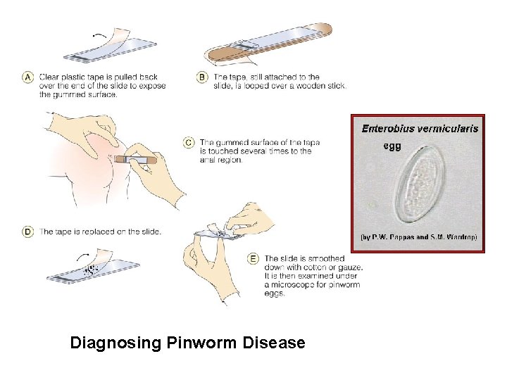 Diagnosing Pinworm Disease Diagnosing Pinworm Disease