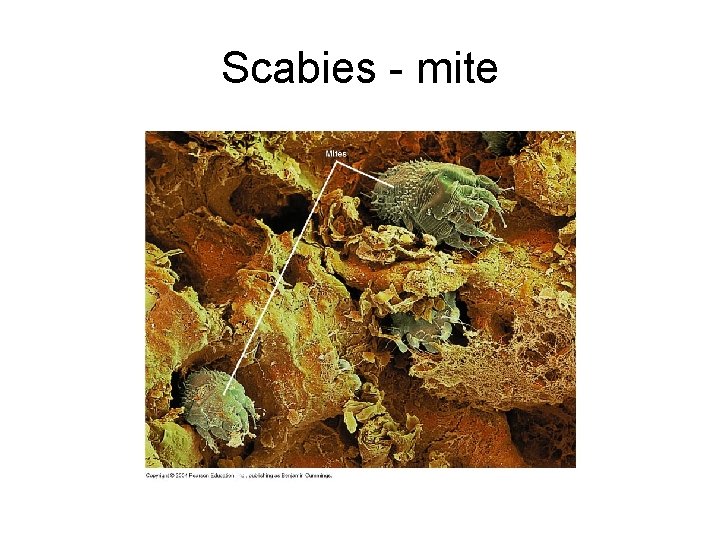 Scabies - mite Scabies - mite