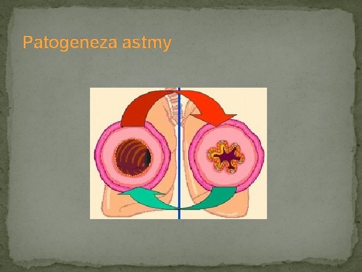 Patogeneza astmy 