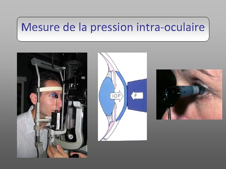 Mesure de la pression intra-oculaire 