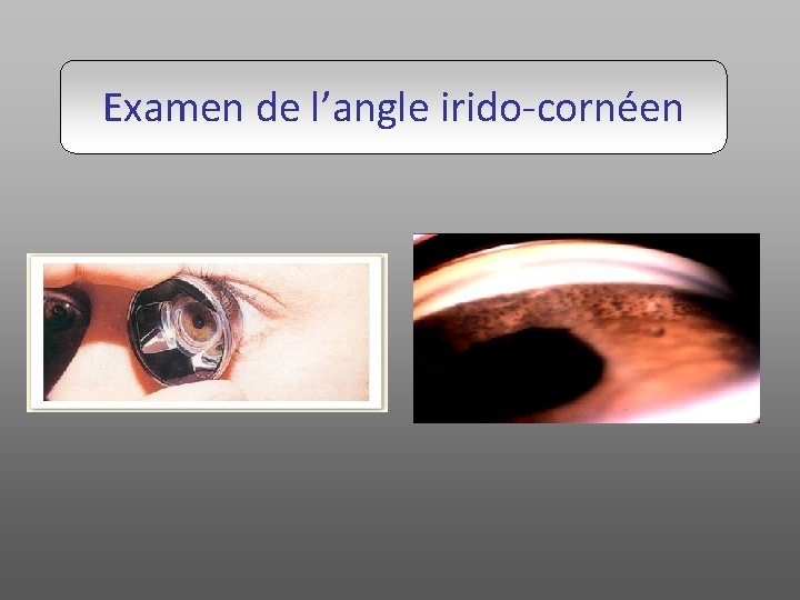 Examen de l’angle irido-cornéen 