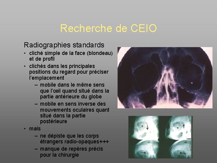 Recherche de CEIO Radiographies standards • cliché simple de la face (blondeau) et de