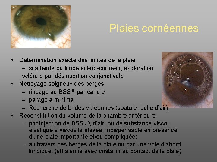 Plaies cornéennes • Détermination exacte des limites de la plaie – si atteinte du