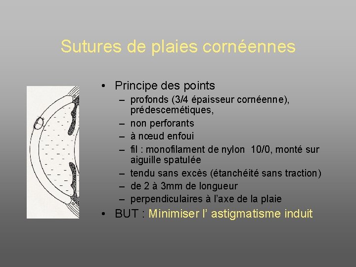 Sutures de plaies cornéennes • Principe des points – profonds (3/4 épaisseur cornéenne), prédescemétiques,