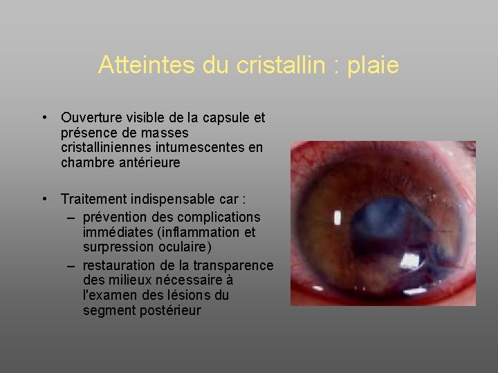 Atteintes du cristallin : plaie • Ouverture visible de la capsule et présence de