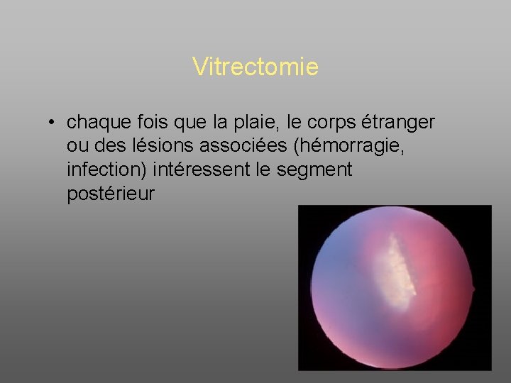 Vitrectomie • chaque fois que la plaie, le corps étranger ou des lésions associées