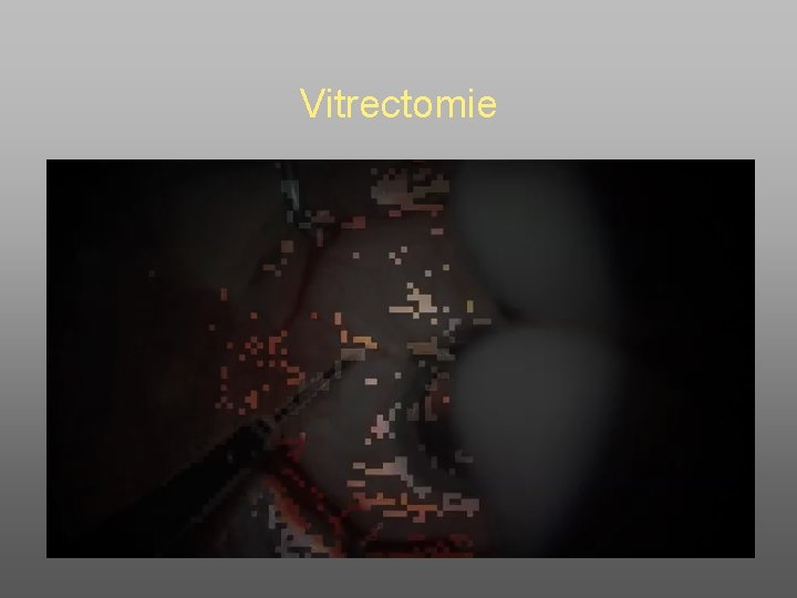 Vitrectomie 