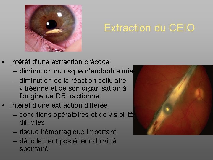 Extraction du CEIO • Intérêt d’une extraction précoce – diminution du risque d’endophtalmie –