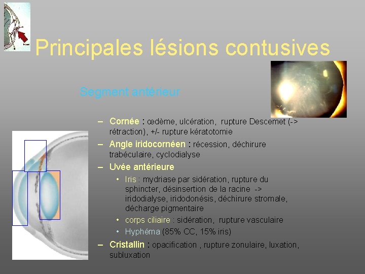 Principales lésions contusives Segment antérieur – Cornée : œdème, ulcération, rupture Descemet (-> rétraction),