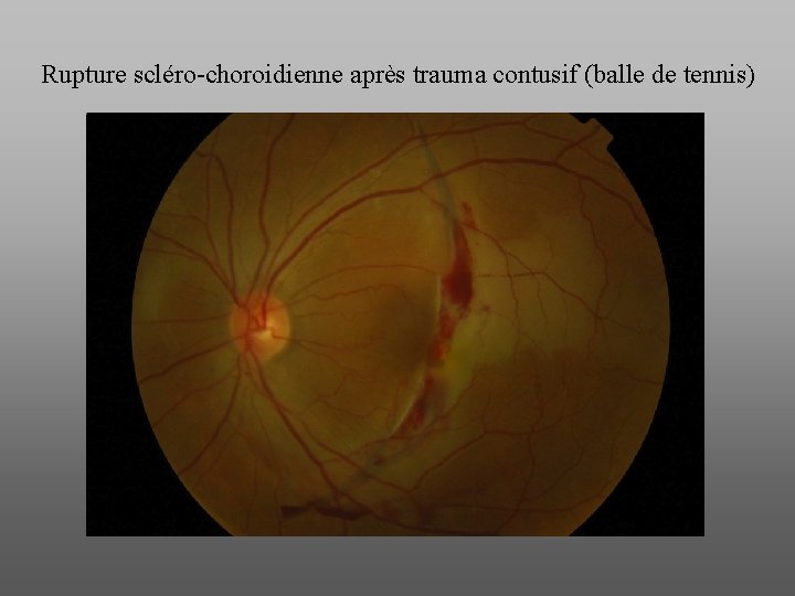 Rupture scléro-choroidienne après trauma contusif (balle de tennis) 