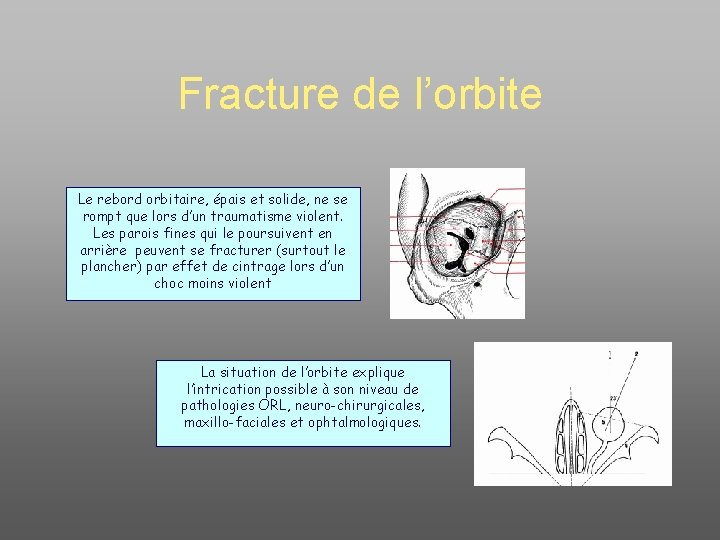 Fracture de l’orbite Le rebord orbitaire, épais et solide, ne se rompt que lors