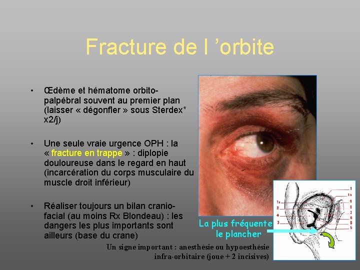 Fracture de l ’orbite • Œdème et hématome orbitopalpébral souvent au premier plan (laisser