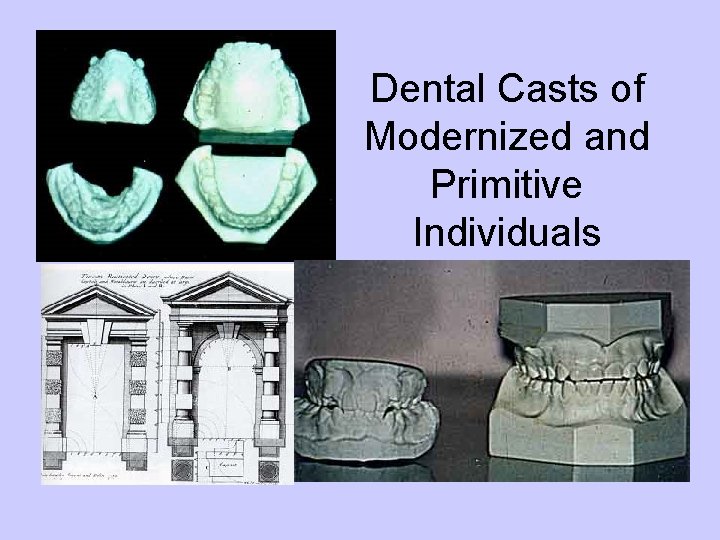 Dental Casts of Modernized and Primitive Individuals 