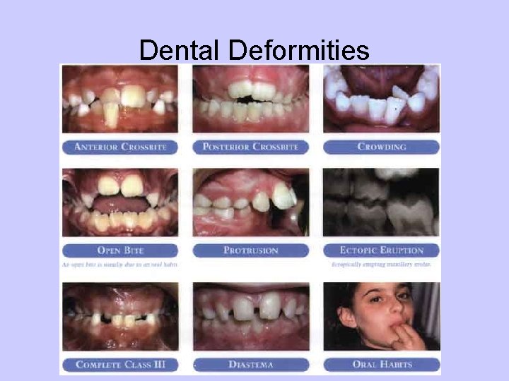 Dental Deformities 