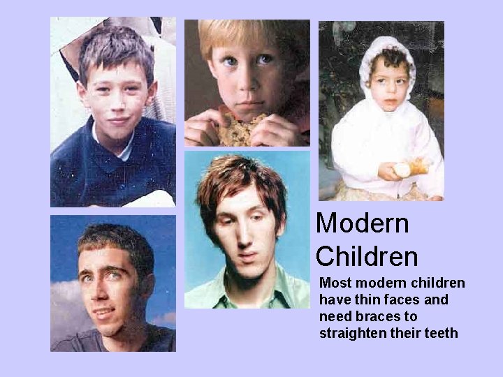 Modern Children Most modern children have thin faces and need braces to straighten their