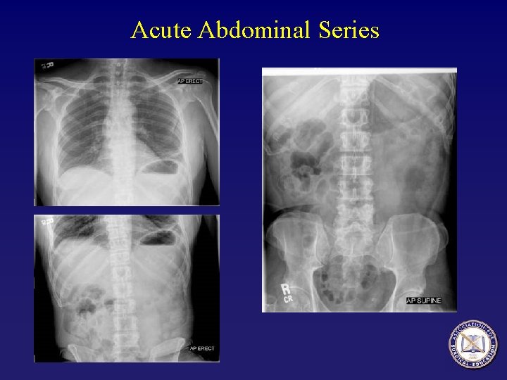 Acute Abdominal Series 