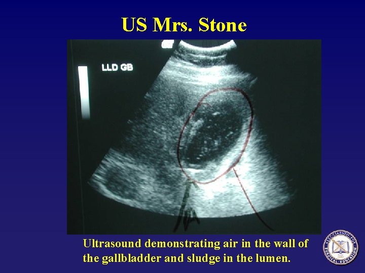 US Mrs. Stone Ultrasound demonstrating air in the wall of the gallbladder and sludge