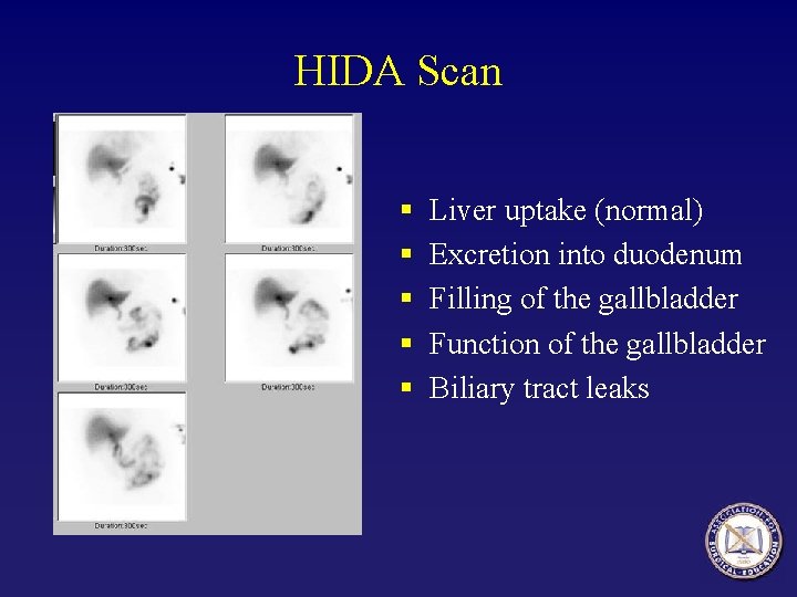 HIDA Scan § § § Liver uptake (normal) Excretion into duodenum Filling of the