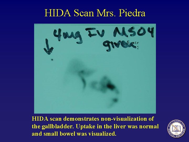 HIDA Scan Mrs. Piedra HIDA scan demonstrates non-visualization of the gallbladder. Uptake in the