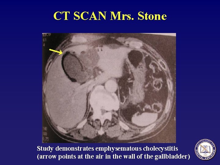 CT SCAN Mrs. Stone Study demonstrates emphysematous cholecystitis (arrow points at the air in