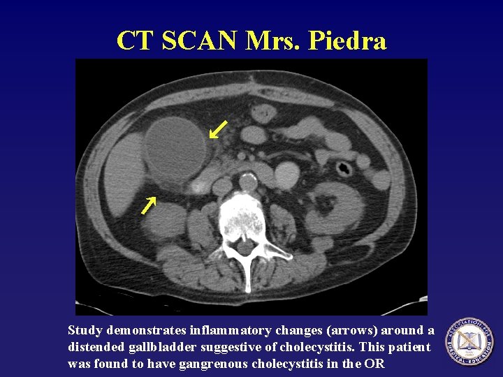 CT SCAN Mrs. Piedra Study demonstrates inflammatory changes (arrows) around a distended gallbladder suggestive