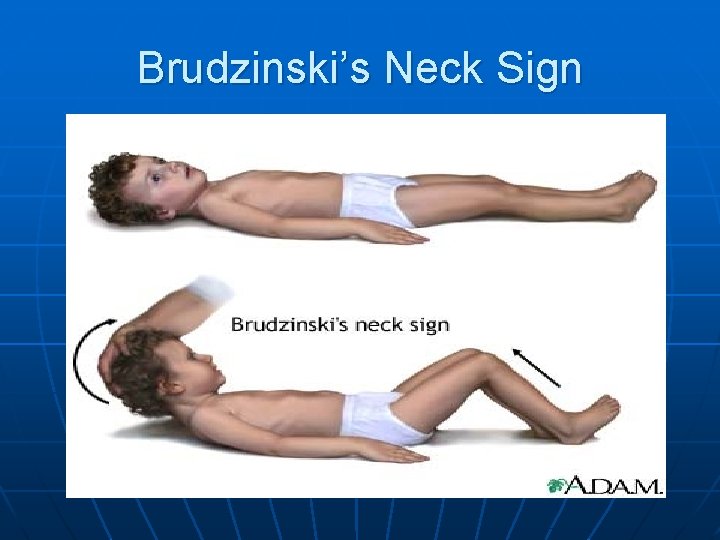 Brudzinski’s Neck Sign 