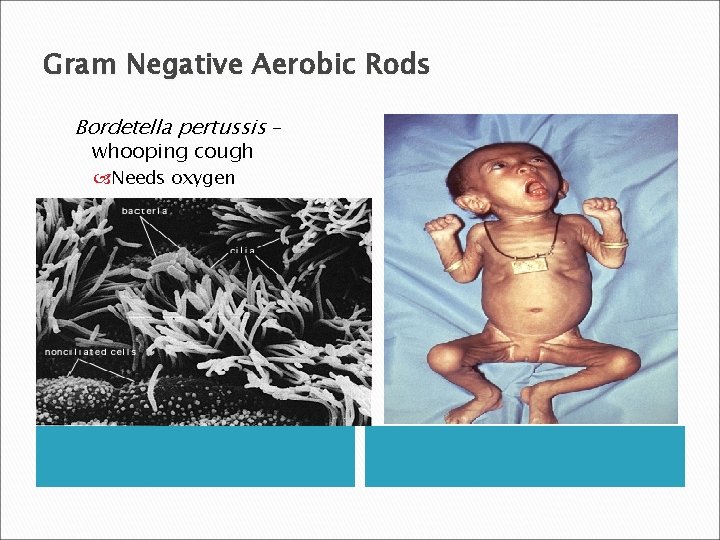 Gram Negative Aerobic Rods Bordetella pertussis – whooping cough Needs oxygen 