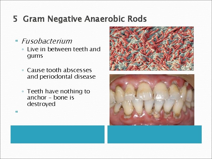 5 Gram Negative Anaerobic Rods Fusobacterium ◦ Live in between teeth and gums ◦