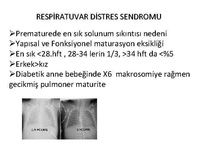 RESPİRATUVAR DİSTRES SENDROMU ØPrematurede en sık solunum sıkıntısı nedeni ØYapısal ve Fonksiyonel maturasyon eksikliği