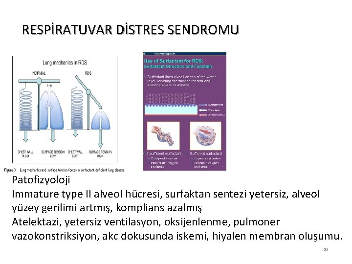 RESPİRATUVAR DİSTRES SENDROMU Patofizyoloji Immature type II alveol hücresi, surfaktan sentezi yetersiz, alveol yüzey