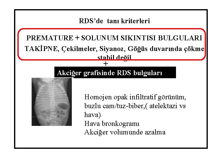 RDS’de tanı kriterleri PREMATURE + SOLUNUM SIKINTISI BULGULARI TAKİPNE, Çekilmeler, Siyanoz, Göğüs duvarında çökme RDS’de tanı kriterleri PREMATURE + SOLUNUM SIKINTISI BULGULARI TAKİPNE, Çekilmeler, Siyanoz, Göğüs duvarında çökme