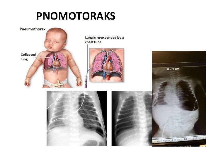 PNOMOTORAKS 