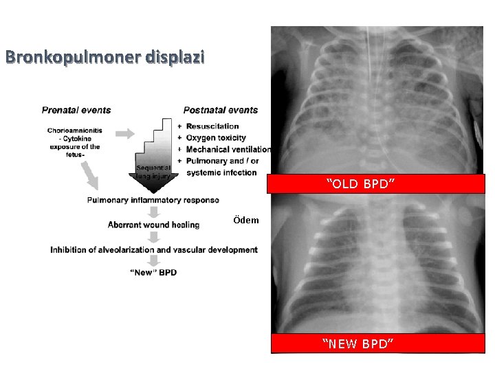 Bronkopulmoner displazi “OLD BPD” Ödem “NEW BPD” 32 
