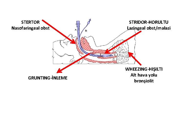 STERTOR Nasofaringeal obst GRUNTING-İNLEME STRIDOR-HORULTU Laringeal obst/malazi WHEEZING-HIŞILTI Alt hava yolu bronşiolit 