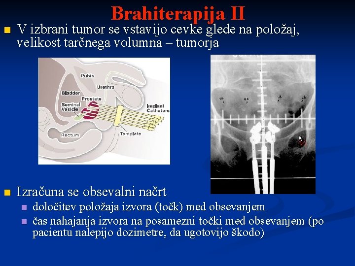 Brahiterapija II n V izbrani tumor se vstavijo cevke glede na položaj, velikost tarčnega