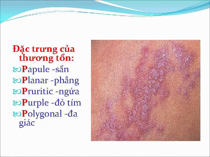 Đặc trưng của thương tổn: Papule -sẩn Planar -phẳng Pruritic -ngứa Purple -đỏ tím