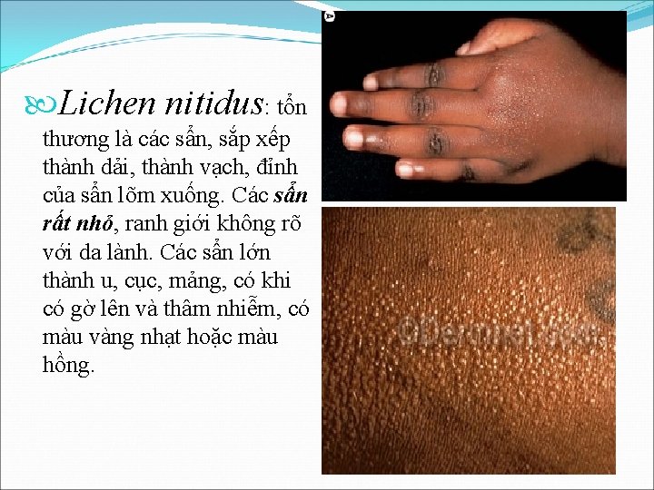  Lichen nitidus: tổn thương là các sẩn, sắp xếp thành dải, thành vạch,