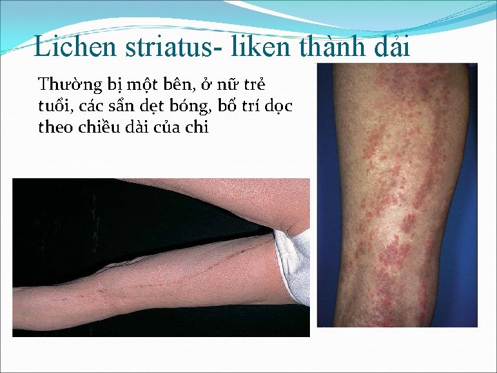 Lichen striatus- liken thành dải Thường bị một bên, ở nữ trẻ tuổi, các