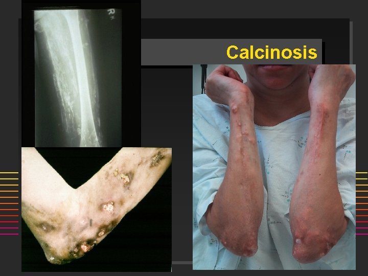 Calcinosis 