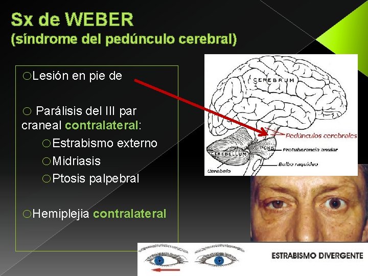 Sx de WEBER (síndrome del pedúnculo cerebral) o. Lesión en pie de o Parálisis