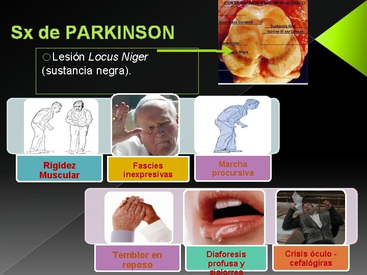 Sx de PARKINSON o. Lesión Locus Niger (sustancia negra). Rigidez Muscular Fascies inexpresivas Temblor