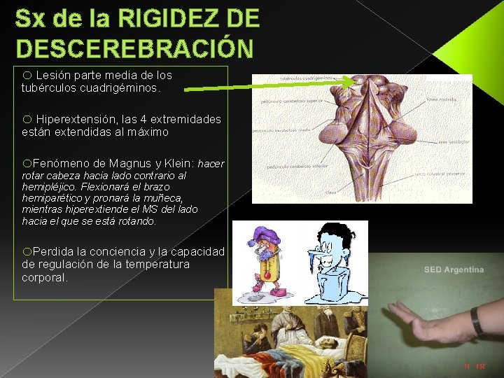 Sx de la RIGIDEZ DE DESCEREBRACIÓN o Lesión parte media de los tubérculos cuadrigéminos.